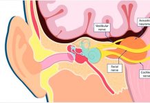 Tratamiento de Tumores Cerebrales con Radiocirugía