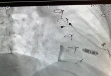 Hospital San José realizó el primer implante en América del Sur de marcapasos único a nivel mundial