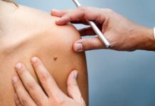 Día del melanoma: Soc. de cancerología advierte sobre cáncer de rápida evolución