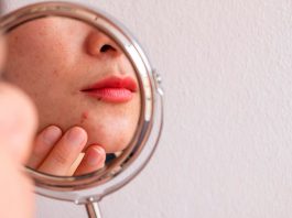Acné: consejos clave para tratar correctamente esta enfermedad