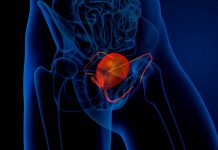 ¿Qué es lo primero que ves Novedosa campaña orienta a pacientes acerca del cáncer de vejiga