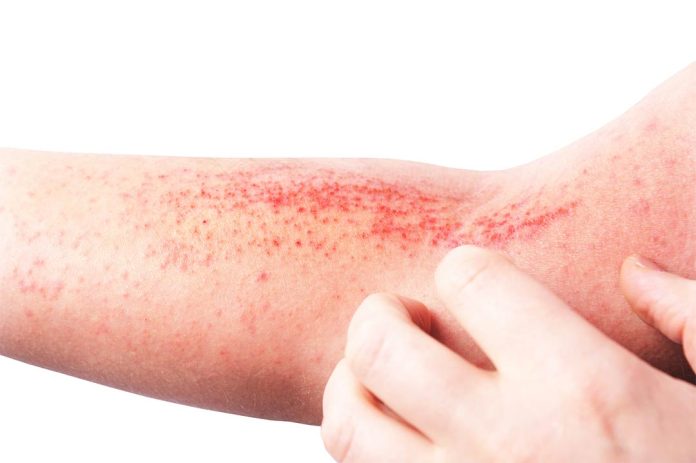 Dermatitis Atópica Una enfermedad que marca la piel e impacta en la calidad de vida de miles de chilenos