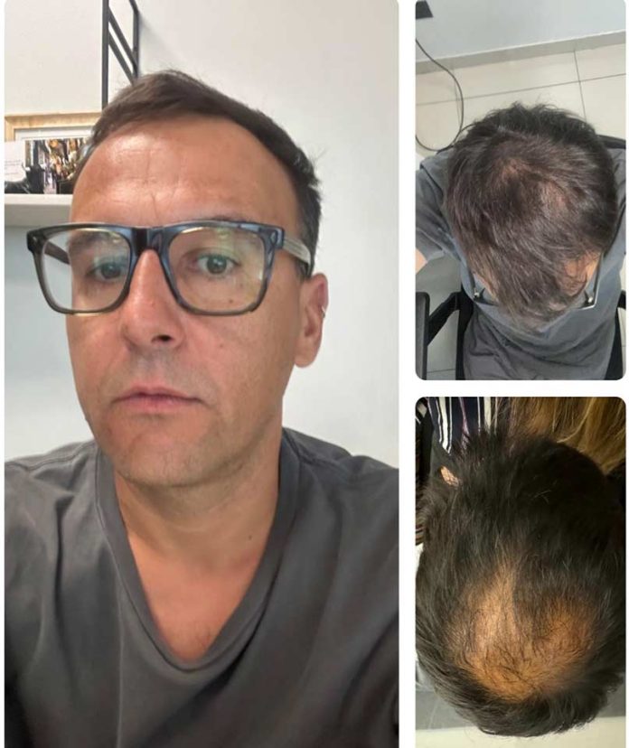 No invasivo y libre de químicos: Ingeniero probó innovador tratamiento contra la caída del cabello con impresionantes resultados