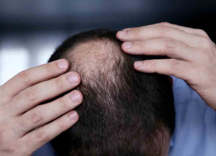 La autoestima de los hombres que se esfuma con la pérdida de cabello