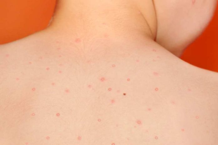 Piojos, verrugas y moluscos contagiosos: Cómo enfrentar a los intrusos del verano