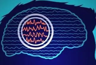 Estudio: La estimulación cerebral profunda personalizada podría tratar la epilepsia resistente a los fármacos