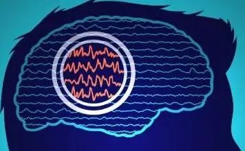 Estudio: La estimulación cerebral profunda personalizada podría tratar la epilepsia resistente a los fármacos