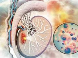Autoexamen y PET‑CT: dos aliados clave para curar el cáncer testicular
