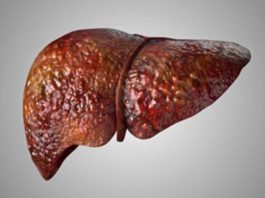 Investigadores de Mayo Clinic asocian mutación hereditaria con enfermedad del hígado graso