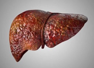Investigadores de Mayo Clinic asocian mutación hereditaria con enfermedad del hígado graso