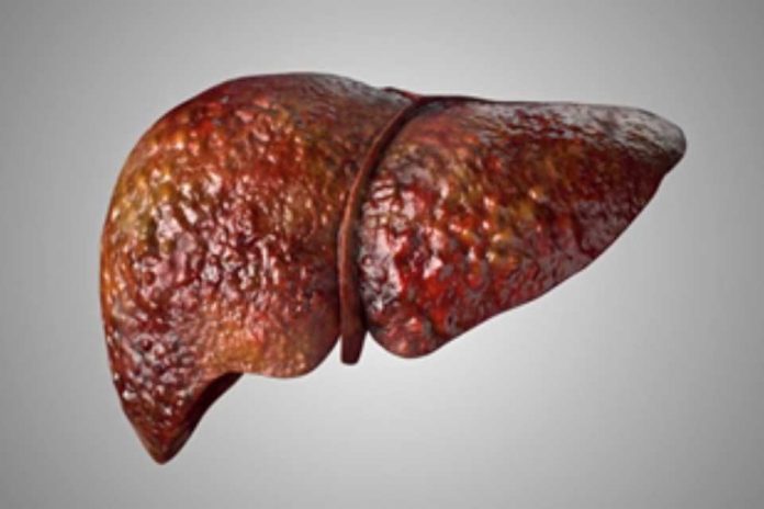 Investigadores de Mayo Clinic asocian mutación hereditaria con enfermedad del hígado graso