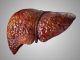 Investigadores de Mayo Clinic asocian mutación hereditaria con enfermedad del hígado graso