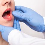 Detectar a tiempo puede salvar vidas: Expertos alertan sobre el cáncer mandibular y sus síntomas más comunes