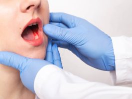 Detectar a tiempo puede salvar vidas: Expertos alertan sobre el cáncer mandibular y sus síntomas más comunes