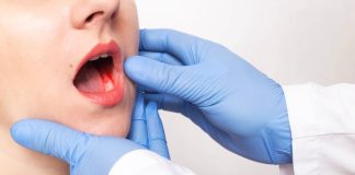 Detectar a tiempo puede salvar vidas: Expertos alertan sobre el cáncer mandibular y sus síntomas más comunes