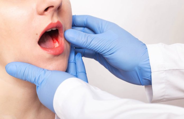 Detectar a tiempo puede salvar vidas: Expertos alertan sobre el cáncer mandibular y sus síntomas más comunes