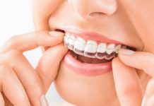 Gracias a la IA tratamientos de brackets invisibles bajan costos y tiempos