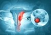Novedosa terapia de PET‑CT redefine el tratamiento del cáncer de ovario
