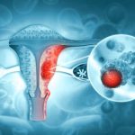 Novedosa terapia de PET‑CT redefine el tratamiento del cáncer de ovario