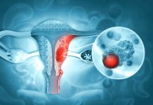 Novedosa terapia de PET‑CT redefine el tratamiento del cáncer de ovario