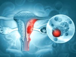 Novedosa terapia de PET‑CT redefine el tratamiento del cáncer de ovario