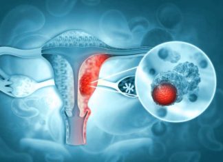 Novedosa terapia de PET‑CT redefine el tratamiento del cáncer de ovario