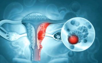Novedosa terapia de PET‑CT redefine el tratamiento del cáncer de ovario
