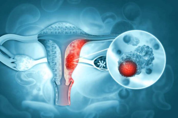Novedosa terapia de PET‑CT redefine el tratamiento del cáncer de ovario