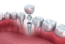 Implantes dentales: nuevas tecnologías subsanan la atrofia del hueso maxilar