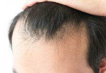 Alopecia masculina: sí podría ser reversible