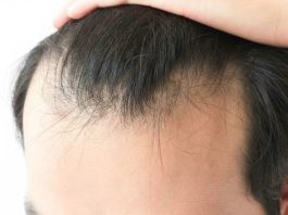 Alopecia masculina: sí podría ser reversible