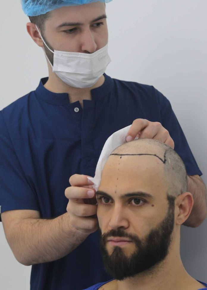 Chile y la revolución de los implantes de cabello: Clínica turca aterriza en Santiago