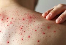 “Es altamente contagiosa y puede ser mortal”: Experto alerta riesgos del sarampión en medio de baja vacunación infantil