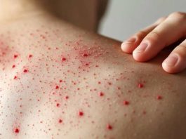 “Es altamente contagiosa y puede ser mortal”: Experto alerta riesgos del sarampión en medio de baja vacunación infantil