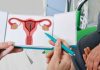 Anticoncepción sin hormonas: una opción válida, segura y cada vez más elegida