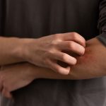 Escarlatina en la región del Maule: autoridades sanitarias en alerta por aumento de casos