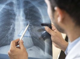 Mayo Clinic en Arizona anuncia el lanzamiento de un nuevo programa de trasplante de pulmón
