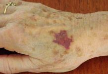 ¿Por qué salen moretones sin golpes en las personas mayores? causas, señales de alerta y cuidados ante hematomas