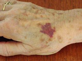 ¿Por qué salen moretones sin golpes en las personas mayores? causas, señales de alerta y cuidados ante hematomas