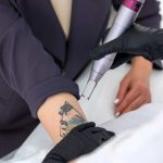 ¿Quieres borrarte un tatuaje?: Especialista entrega consejos y tips para realizarlo de forma segura y efectiva