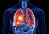 El PET/CT redefine la estadificación de esta enfermedad y reduce cirugías innecesarias