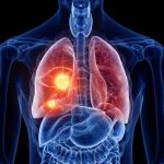 El PET/CT redefine la estadificación de esta enfermedad y reduce cirugías innecesarias