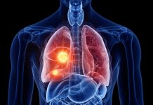 El PET/CT redefine la estadificación de esta enfermedad y reduce cirugías innecesarias