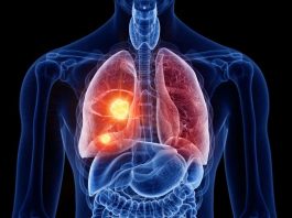 El PET/CT redefine la estadificación de esta enfermedad y reduce cirugías innecesarias