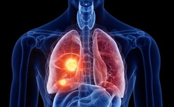 El PET/CT redefine la estadificación de esta enfermedad y reduce cirugías innecesarias