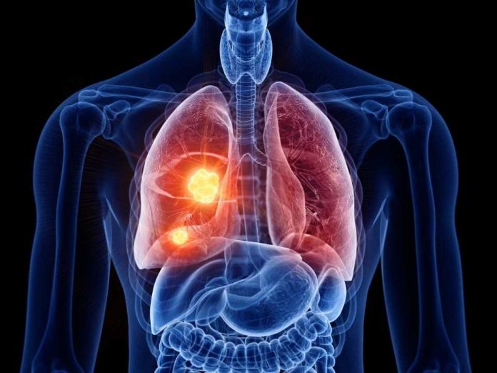 El PET/CT redefine la estadificación de esta enfermedad y reduce cirugías innecesarias
