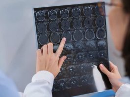 Enfermedades del cerebro: ¿cuáles son las más comunes en Chile?
