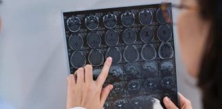 Enfermedades del cerebro: ¿cuáles son las más comunes en Chile?