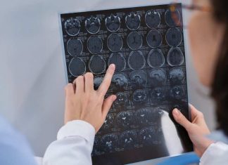 Enfermedades del cerebro: ¿cuáles son las más comunes en Chile?