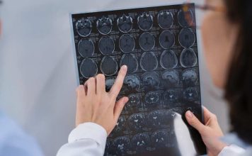 Enfermedades del cerebro: ¿cuáles son las más comunes en Chile?